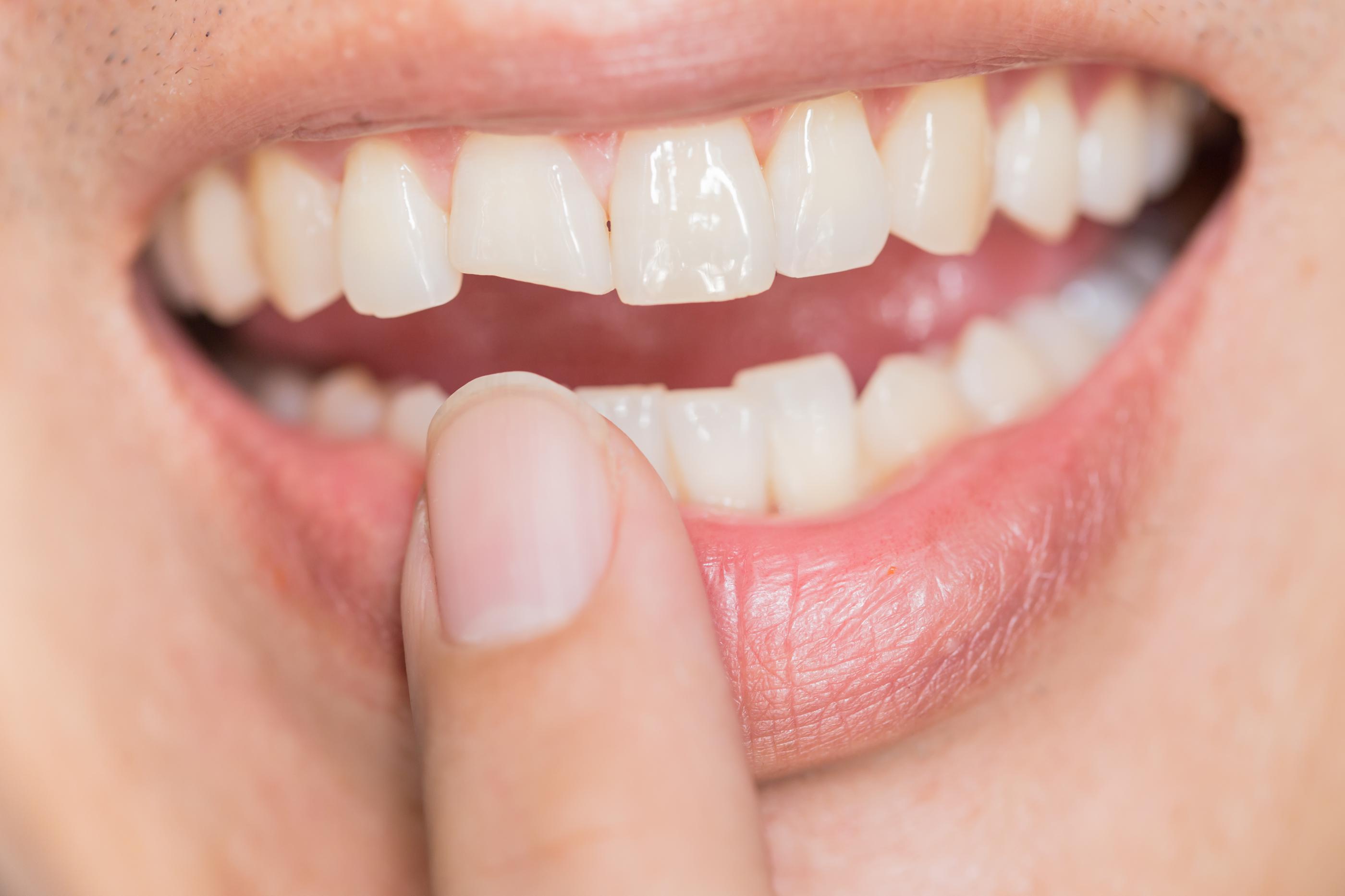 image of woman with a cracked front tooth.