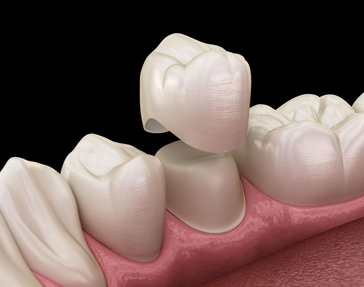 Dental Crowns: Everything You Need to Know
